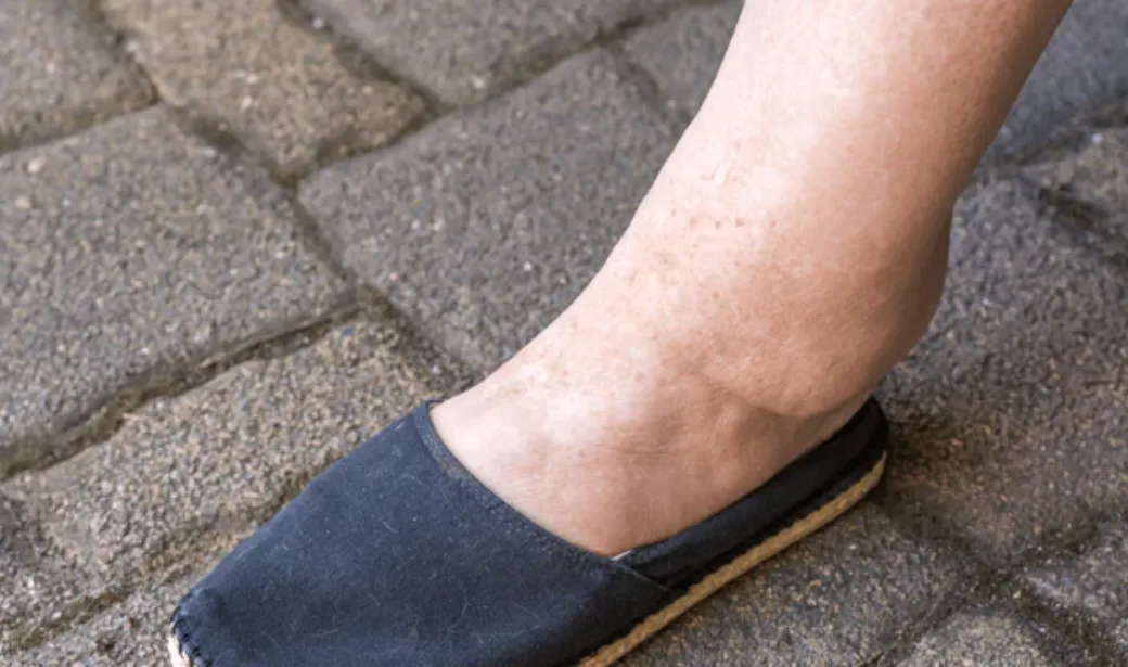 How To Recognise And Reduce Water Retention (EDEMA)